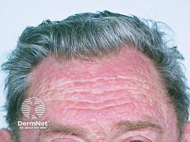 Lichenified eczema over the forehead extending to the hairline due to chronic actinic dermatitis