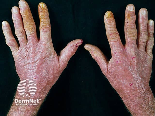 Chronic actinic dermatitis on the dorsal hands with a cut off at the wrists - there is often sparing between the fingers and webs