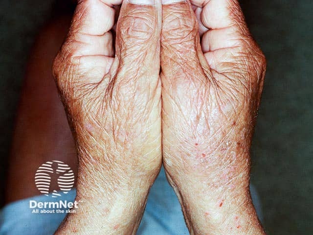 Lichenified chronic actinic dermatitis on the hands; there is sparing of the photoprotected palmar skin