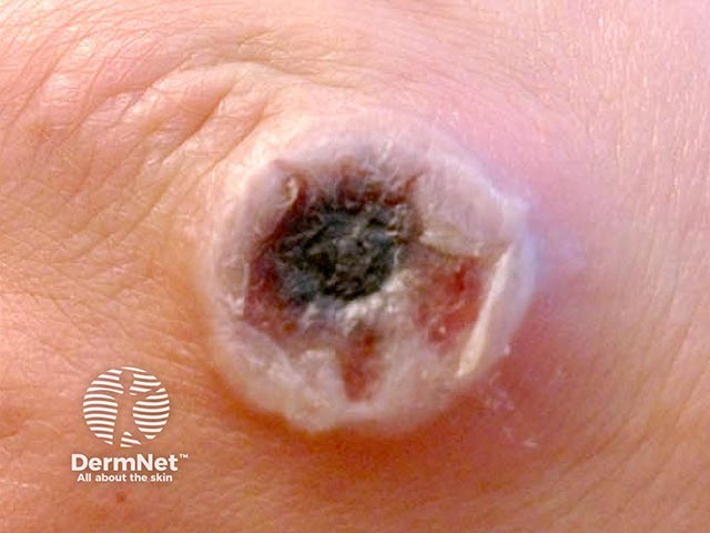 Central necrosis is developing in the blister as the cowpox lesion matures