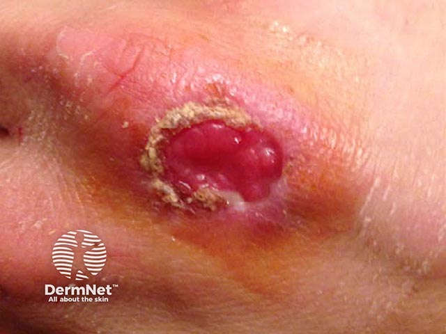 The healing cowpox ulcer