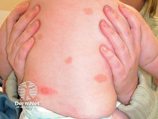 Mastocytosis in a baby - red-brown patches are characteristic.  The left lower back lesion has urticated after rubbing - a positive Darier sign