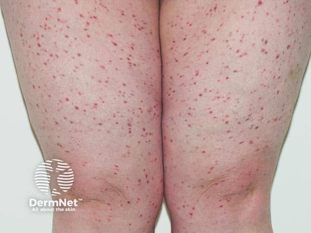 Adult-onset urticaria pigmentosa - the lesions are more red than usual, and are often brown in colour