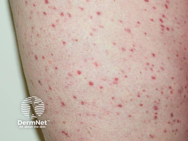 Adult-onset urticaria pigmentosa - the lesions are more red than usual, and are often brown in colour