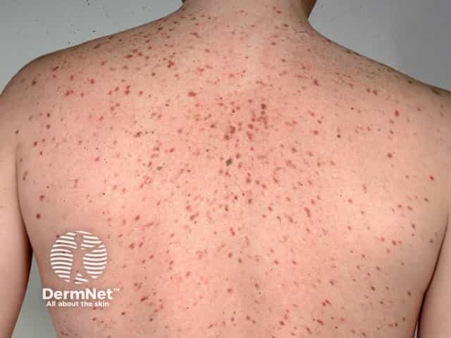 Red-brown monomorphic maculopapules in adult-onset urticaria pigmentosa