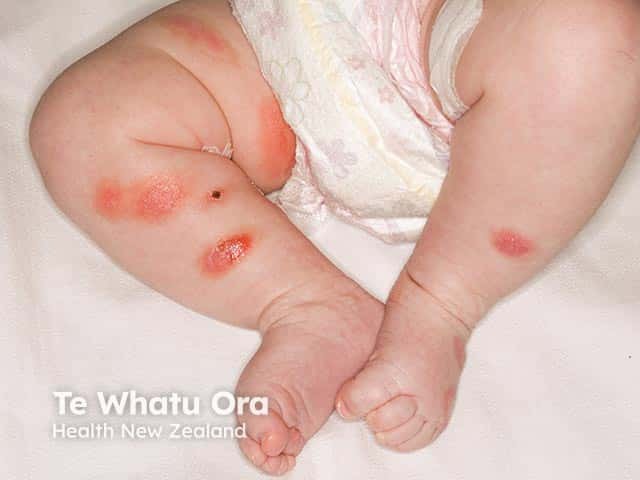 Infantile mastocytosis - some lesions have blistered after urticating due to rubbing