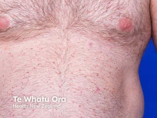 Red monomorphic maculopapules due to a variant of mastocytosis called telangiectasia macularis eruptiva perstans