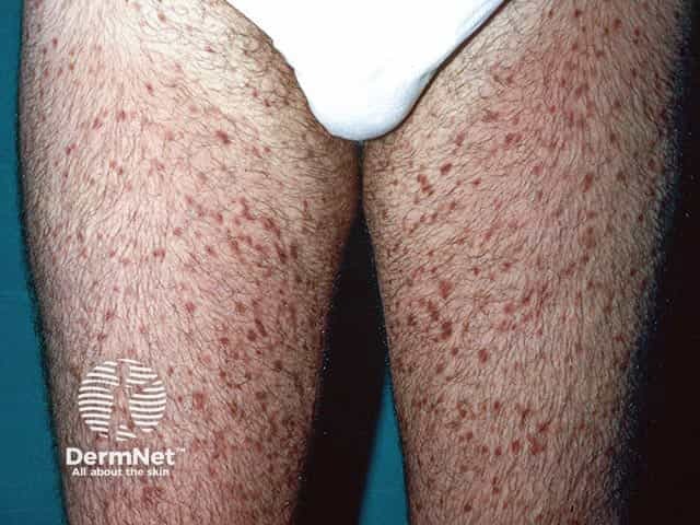 Red-brown maculopapules in adult onset urticaria pigmentosa