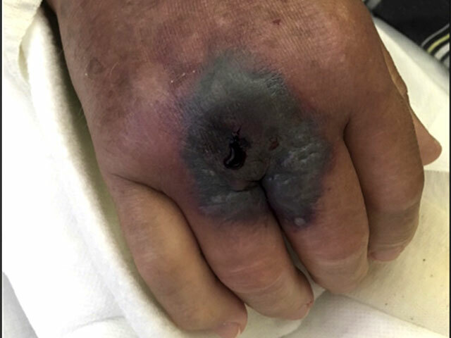 Cutaneous mucormycosis: hand in leukaemia patient.