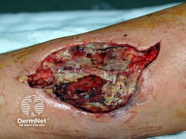 Mucormycosis in a surgical wound