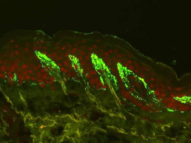 Granular deposits of IgA shown on direct immunofluorescence of perilesional skin (courtesy of Dr Richard Groves, London)