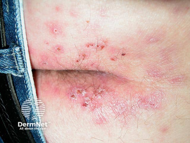 Excoriated vesicles on the buttocks and sacrum in dermatitis herpetiformis