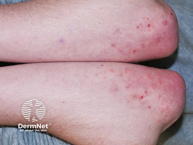 Elbow lesions in dermatitis herpetiformis