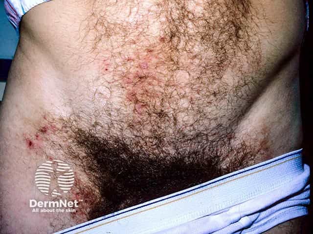 Abdominal and groin dermatitis herpetiformis