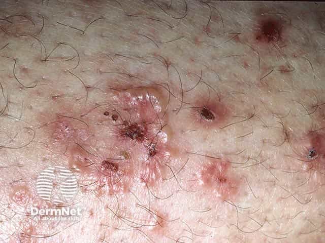 Clustered vesicles on the elbow in dermatitis herpetiformis