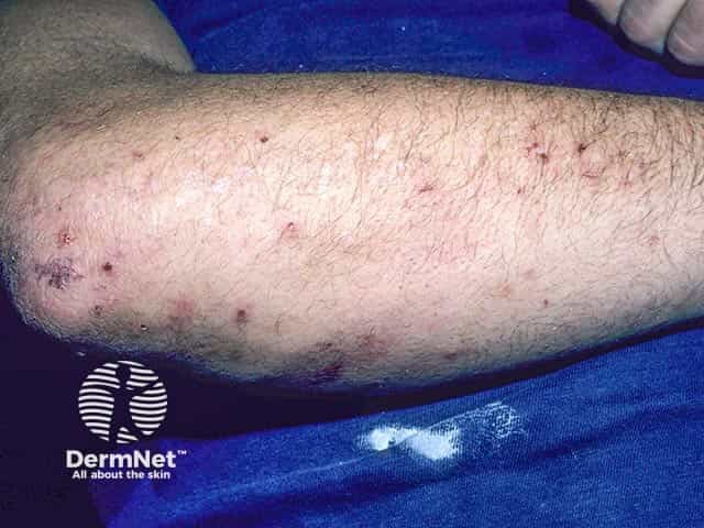 Excoriated vesicles on the arm in dermatitis herpetiformis.  A few intact vesicles are evident