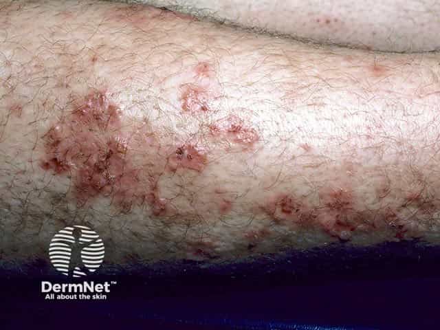 Annular lesions with peripheral vesicles in dermatitis herpetiformis