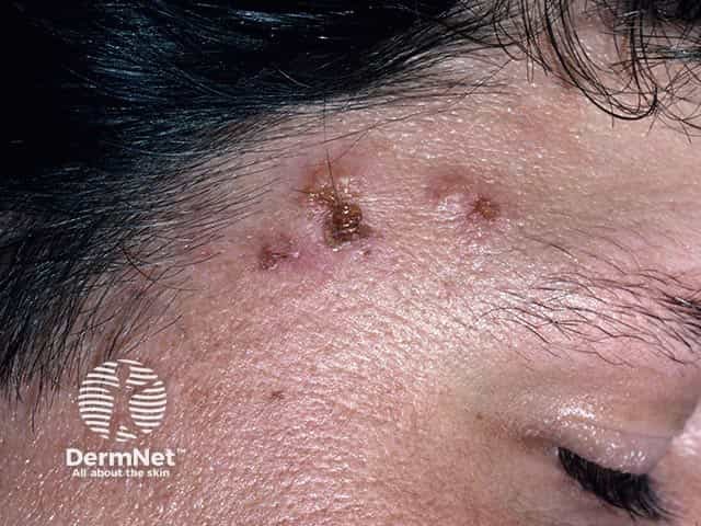 Excoriated vesicles on the temple in dermatitis herpetiformis