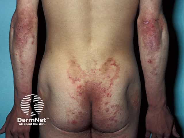 Elbow, sacral and buttock lesions - the classical distribution of dermatitis herpetiformis