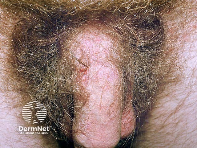 Penile vesicles in dermatitis herpetiformis