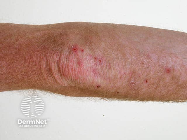 Classical elbow excoriated vesicles in dermatitis herpetiformis