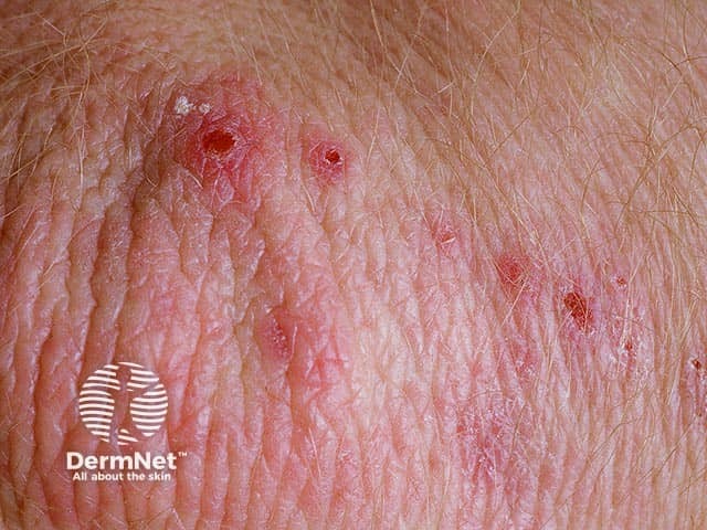 Elbow dermatitis herpetiformis