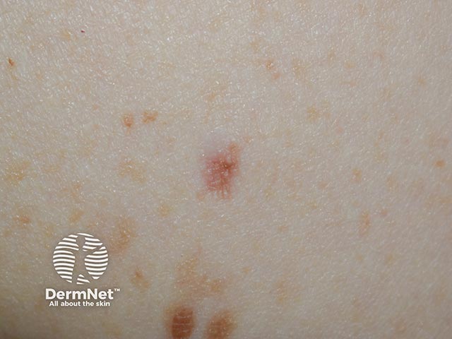 A dermatofibroma on the shoulder - they are often hyperpigmented and 'dip' into the skin.  This can be accentuated by pinching (the pinch sign)