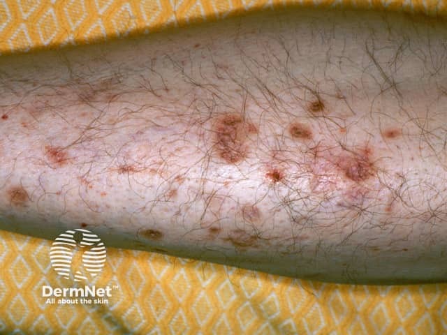 Diabetic shin spots, (diabetic dermopathy) was the clue to diabetes in this comatose patient