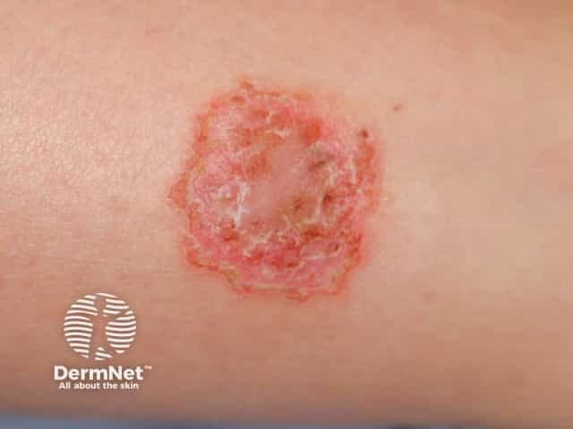 Discoid eczema on the lower leg