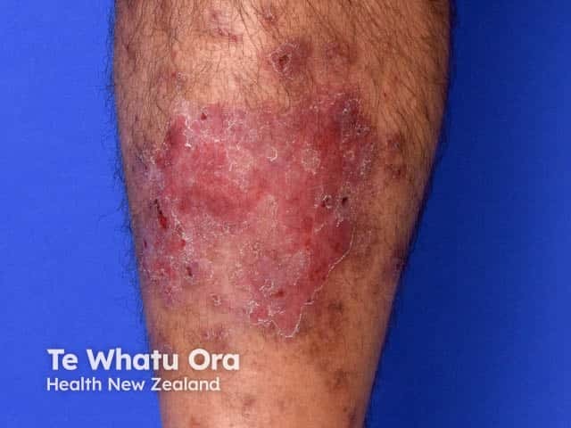 Discoid eczema on the shin