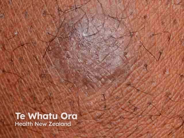 Discoid eczema in skin of colour