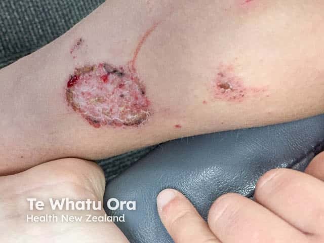 Discoid eczema 