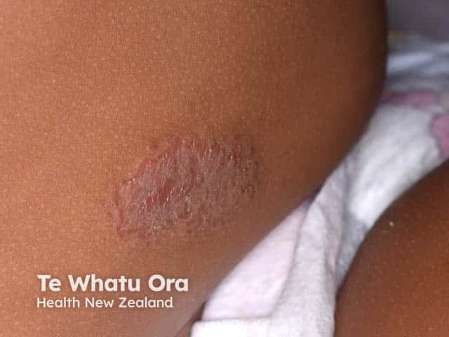 Discoid eczema in an infant 