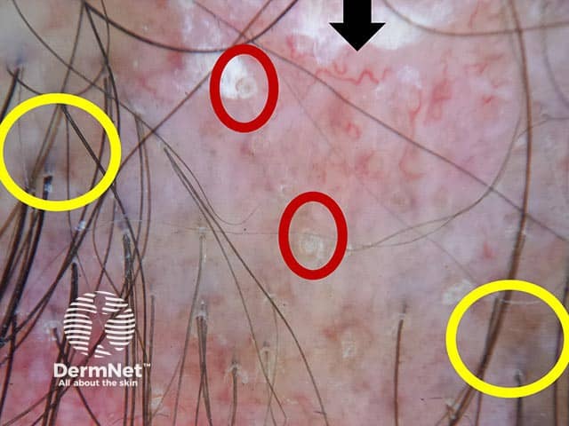 Dermoscopic image showing follicular plugging (red circles), thick arborising vessels (black arrows)  and speckled pigmentation (yellow circles)