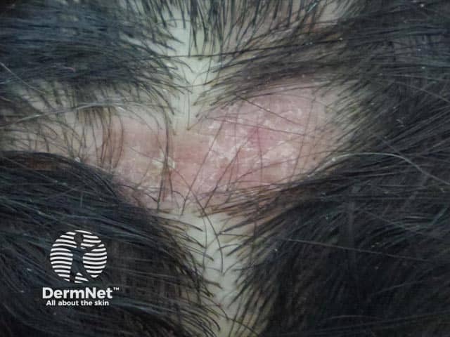 Erythema, scaling and alopecia in scalp discoid lupus erythematosus