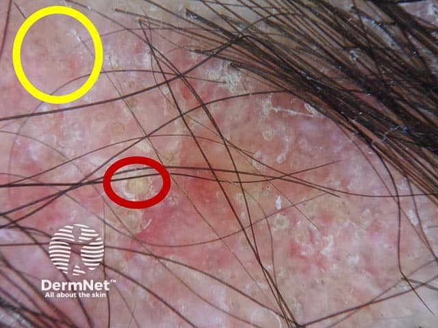 Dermoscopic image showing follicular plugging (red circles) and speckled pigmentation (yellow circle) in discoid lupus erythematosus