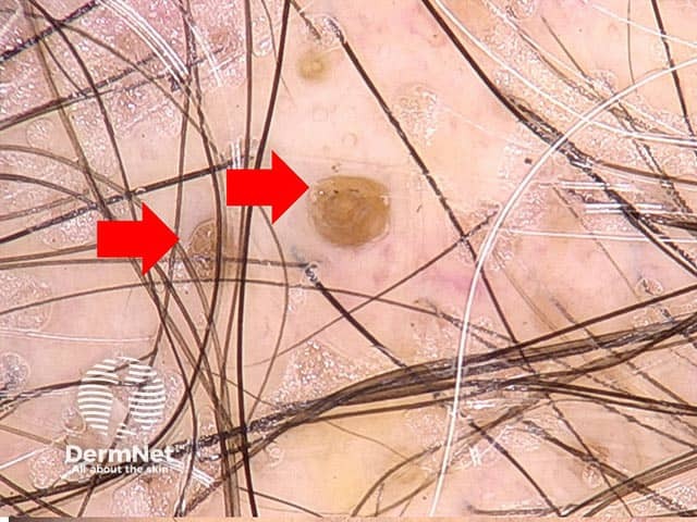 Dermoscopic image showing follicular plugging (red arrows) in discoid lupus erythematosus