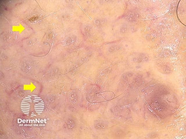 Dermoscopic image showing arborizing blood vessels (yellow arrows)