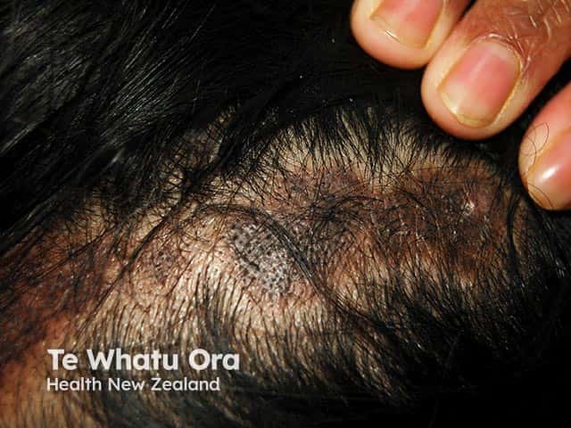 Scarring alopecia in discoid lupus erythematosus