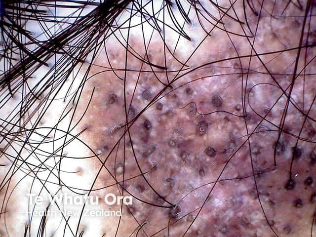 Scarring alopecia with follicular plugging in discoid lupus erythematosus