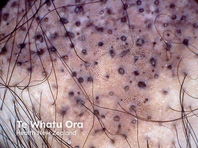 Scarring alopecia with follicular plugging in discoid lupus erythematosus