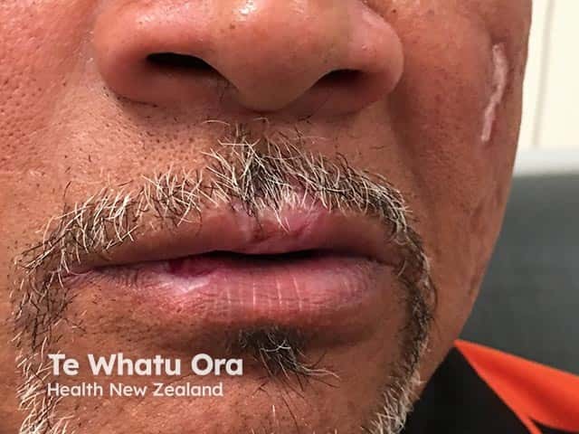 Discoid lupus erythematosus on the lips and cheek