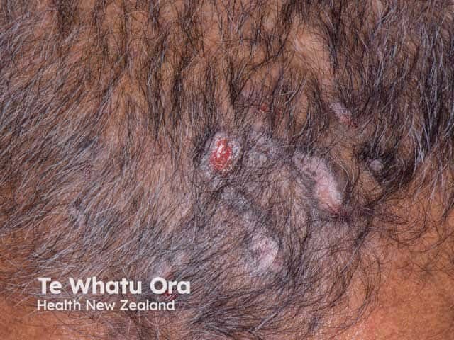 Scarred and ulcerated plaques in the scalp due to discoid lupus erythematosus