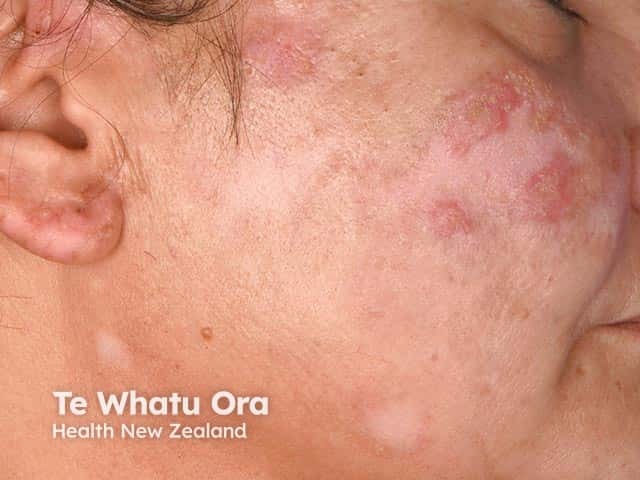 Active inflammatory discoid lupus erythematosus with hypopigmented scarred areas on the cheek