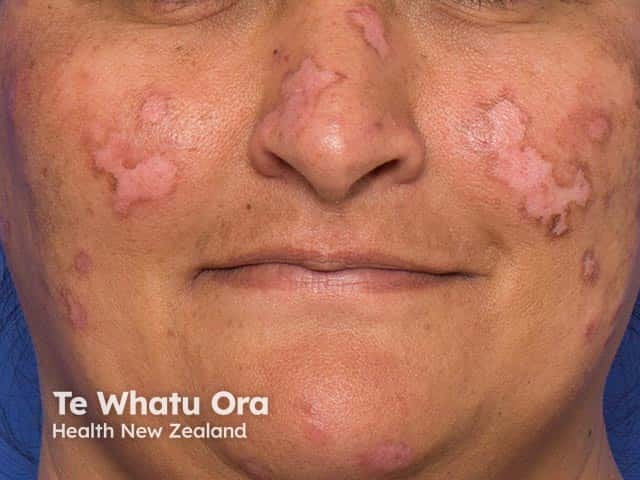 Symmetrical scarred plaques on the face due to discoid lupus erythematosus