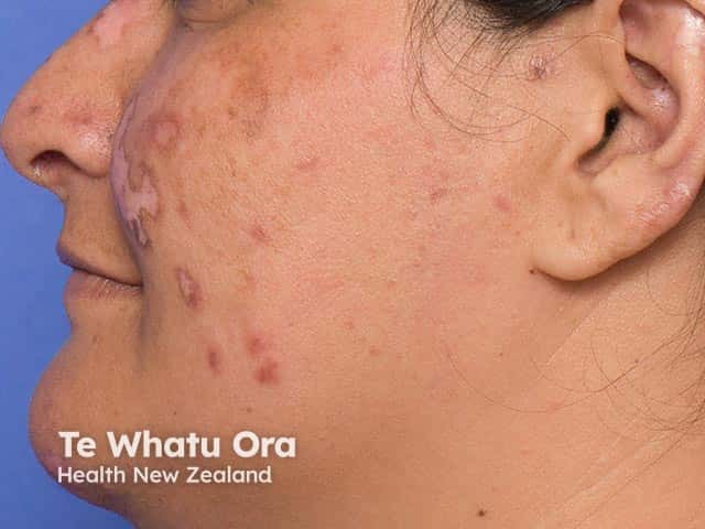 Symmetrical scarred plaques on the face due to discoid lupus erythematosus