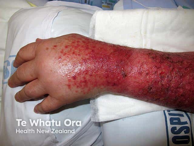 Severe purpuric photosensitivity induced by tamsulosin causing severe oedema of the hand