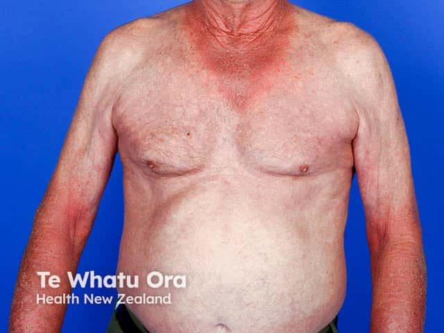 Photosensitivity due to a thiazide diuretic - note the sparing under his T-shirt area