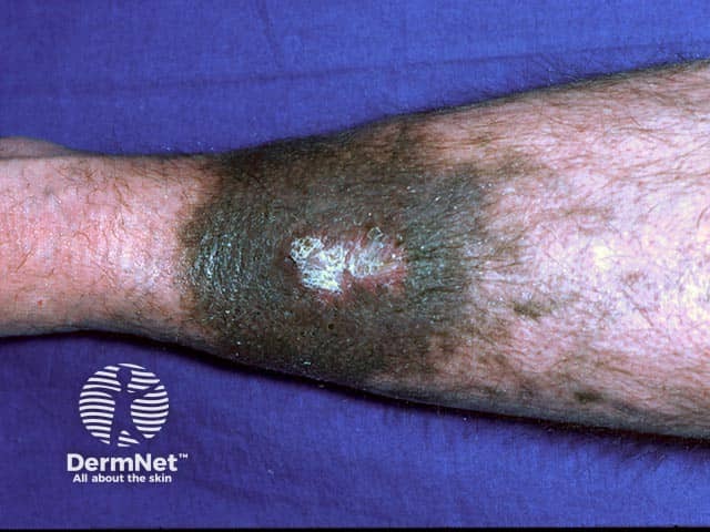 Blue pigmentation due to long-term minocycline use for pyoderma gangrenosum