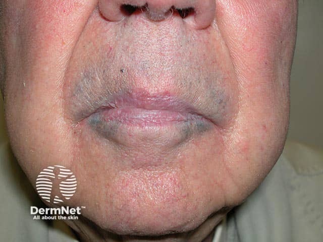 Blue-grey pigmentation due to long term amiodarone use